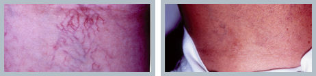 Spider Veins Before and After Results Florham Park