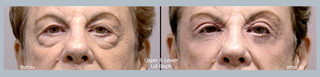 Blepharoplasty Surgery Results North New Jersey