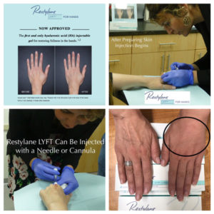 restylane for hands process